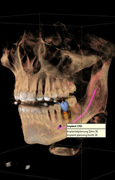 Integruota implantologija